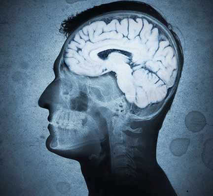 Brain Scan -- cerebral atrophy